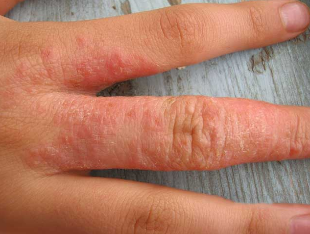 Rashes on the skin when worms
