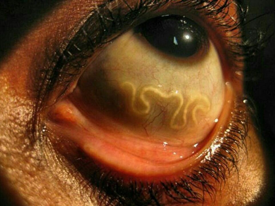 parasites in the human eye